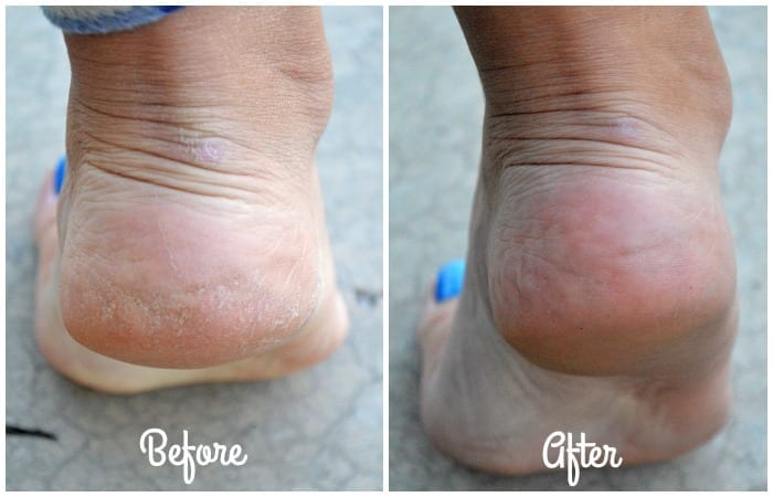 A Cracked Heel Solution That Actually Works