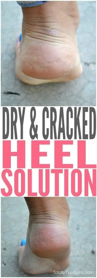 check out this super cool cracked heel solution that actually works!