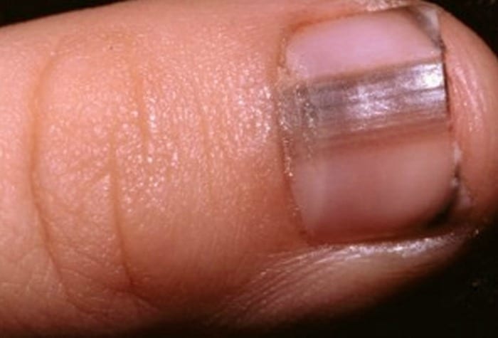 dark links and discoloration under your nails is usually a sign of an infection or possible skin cancer