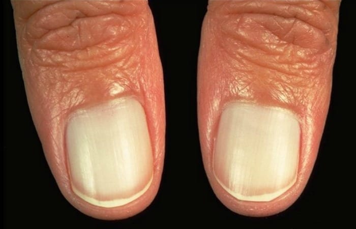 Pale fingernails could mean you have anemia, an iron deficiency