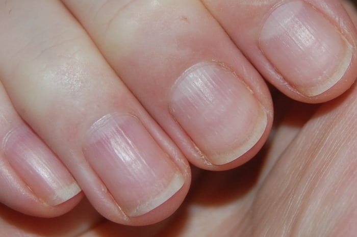 Has anyone ever had a vertical black line on their fingernail? | The DIS  Disney Discussion Forums - DISboards.com