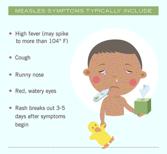 Common measles symptoms