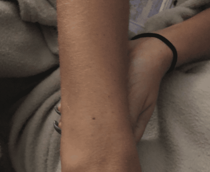 Women Everywhere Are Sharing Pictures of The Freckle They All Have on Their Wrist