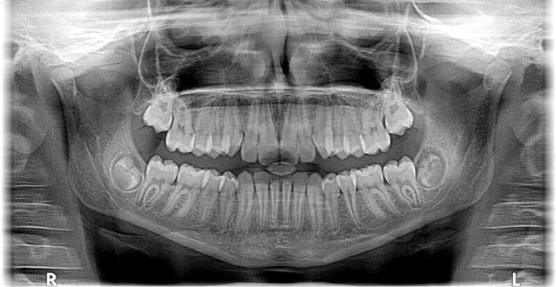 A 7-Year-Old Boy Had 526 Teeth Removed