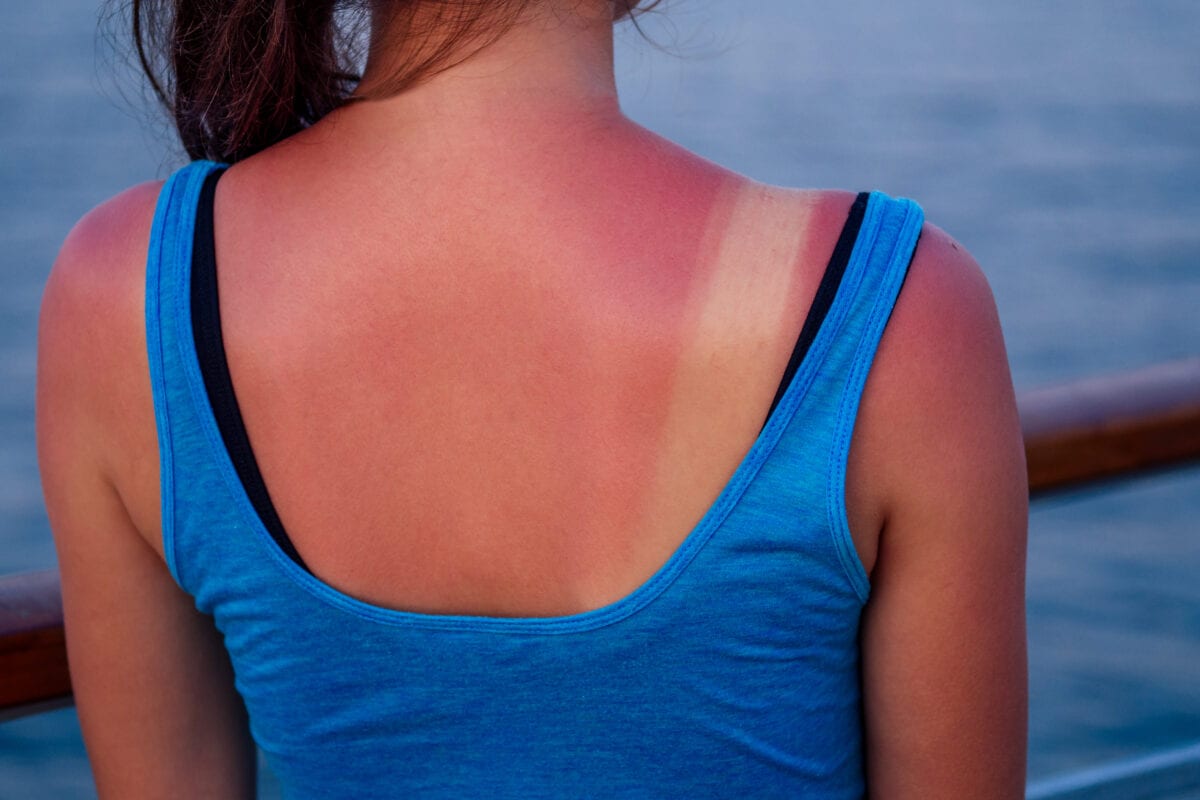 Here’s How You Can Soothe Sunburned Skin at Home
