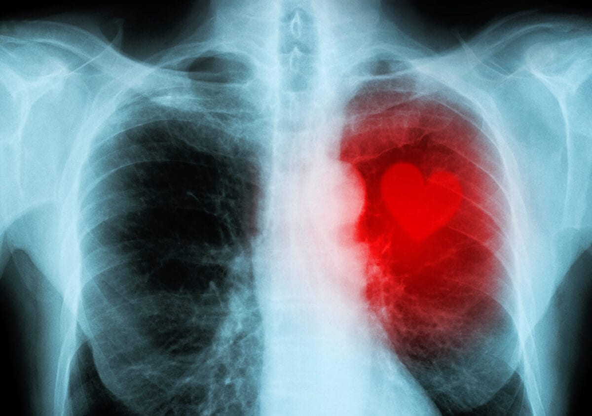 Turns Out, ‘Broken Heart Syndrome’ Is A Real Thing and It’s Increased During The Pandemic