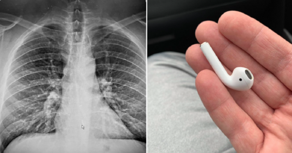 This Guy Swallowed One of His AirPods and He Is Lucky To Be Alive