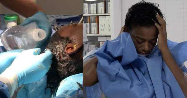 The Woman That Sprayed Her Hair With Gorilla Glue Is Finally Unstuck After Getting Surgery