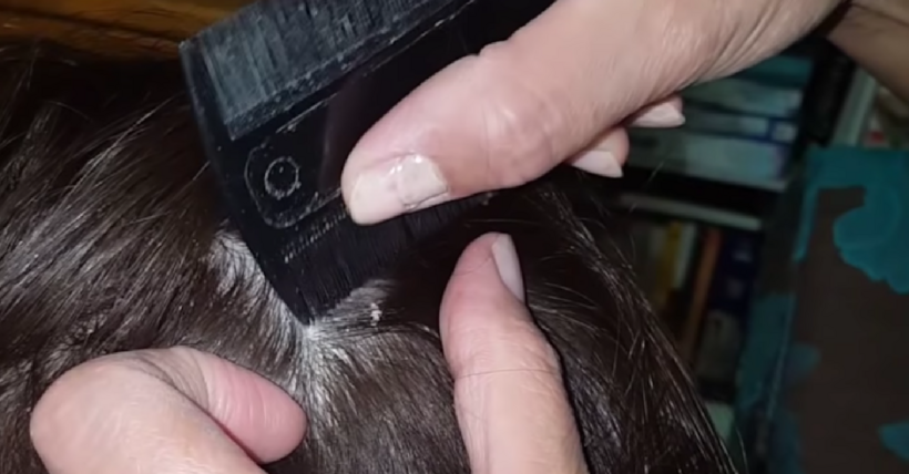 Dandruff Scalp Scraping Videos Are The New Pimple Popping Videos And They Are Oddly Satisfying
