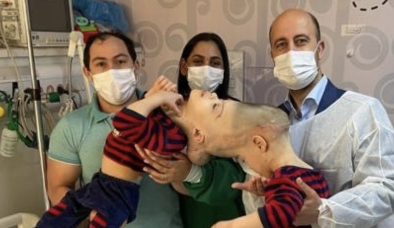 Conjoined Twins With Fused Brains Were Separated In A Historical Surgery And My Heart Is Full