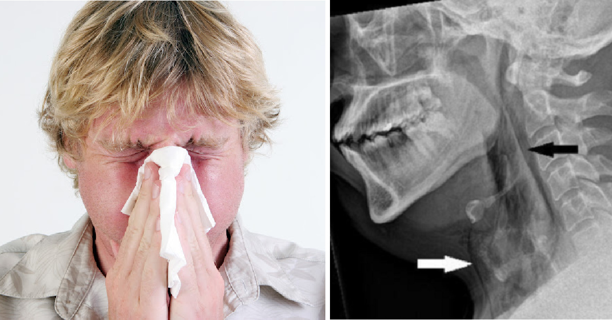 Doctors Issue A Warning After This Man Tore His Throat While Trying To Stop A Sneeze